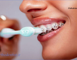 چگونه دندان های ارتودنسی شده را مسواک بزنیم؟