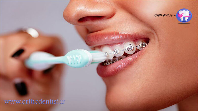 چگونه دندان های ارتودنسی شده را مسواک بزنیم؟
