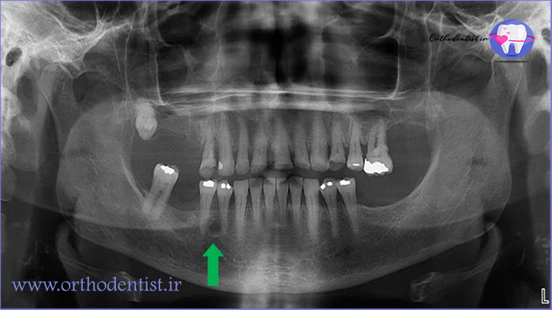 عکس های رادیوگرافی برای تشخیص تحلیل لثه