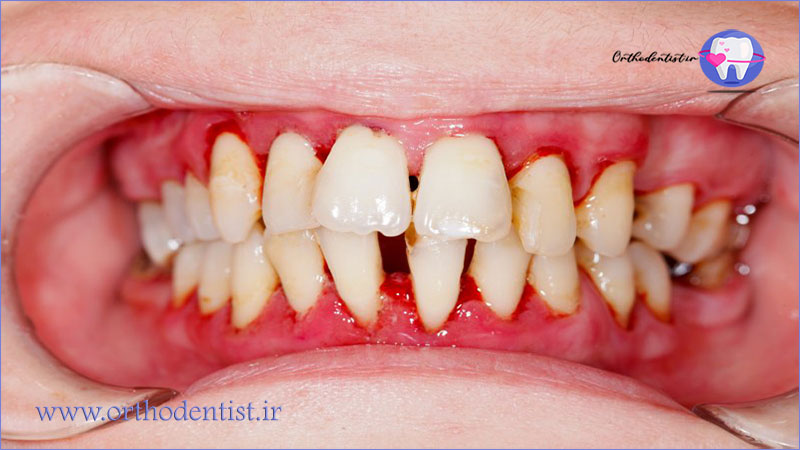 ژنژیویت و پریودنتیت 