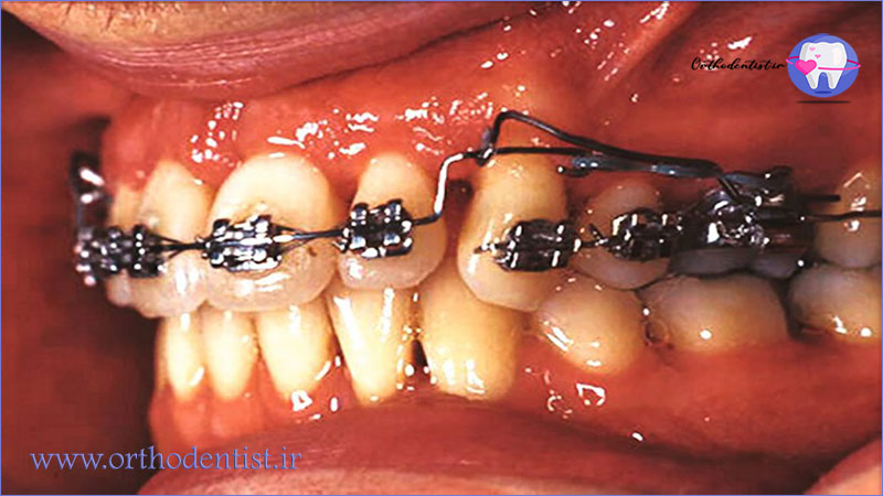 عوارض جانبی مینی پلیت ها در طول ارتودنسی