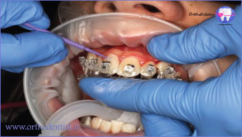 باندینگ ارتودنسی چیست؟