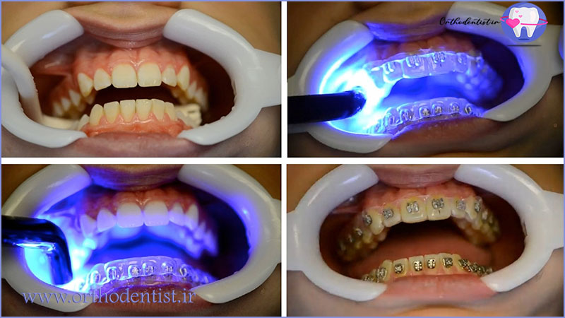مراحل باندینگ ارتودنسی 