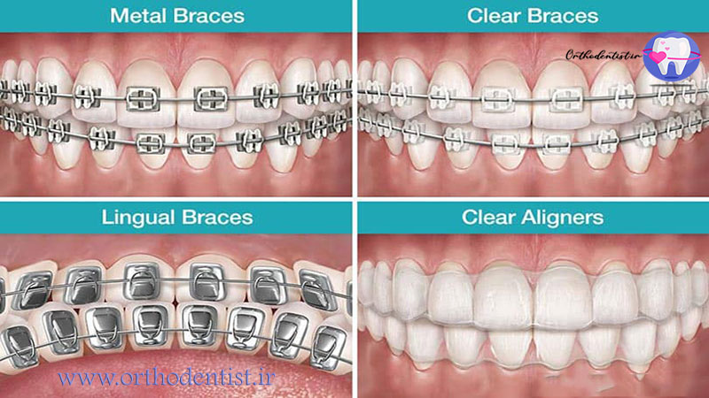 نوع ارتودنسی