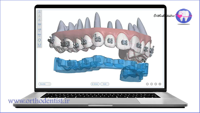 ارتودنسی دیجیتال