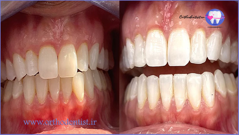 مرتب کردن دندان بدون ارتودنسی