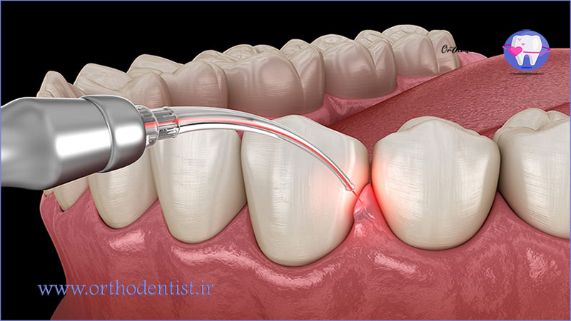 محدودیت ها و معایب لیزر دندانپزشکی